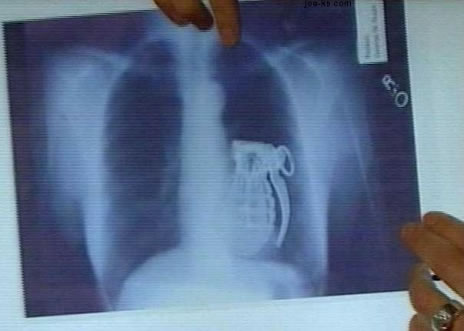 ♣ ภาพ X - Ray ที่ดูแล้วเสียวสุดๆ ♣ 