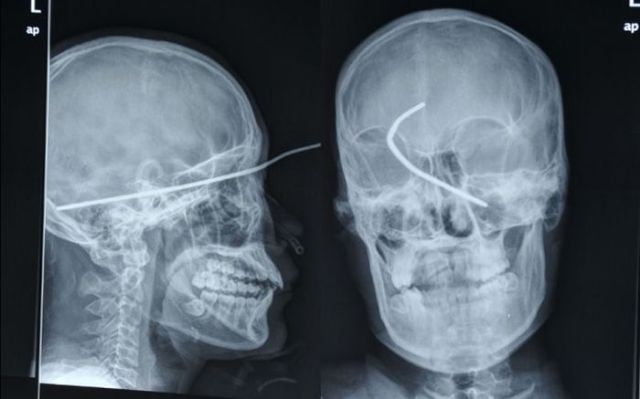 ภาพ X-Rays วัตถุประหลาดในร่างกายมนุษย์