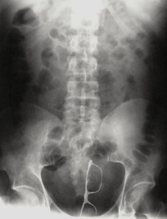 ภาพ X-Rays วัตถุประหลาดในร่างกายมนุษย์