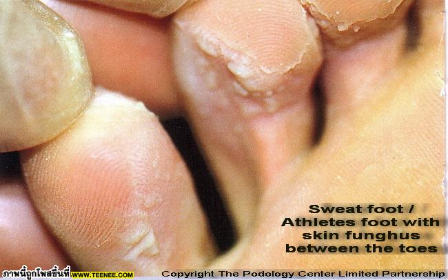 โรคเกี่ยวกับเท้า...อวัยวะสำคัญที่ถูกมองข้าม