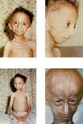 ♣ โรคชราในเด็ก ( Progeria ) ♣ 