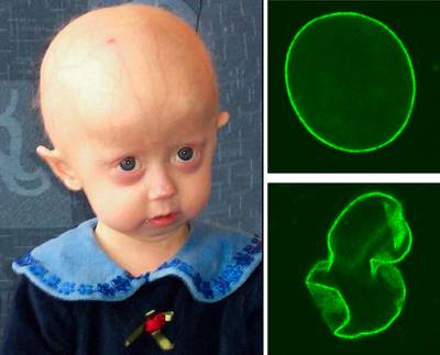 ♣ โรคชราในเด็ก ( Progeria ) ♣ 