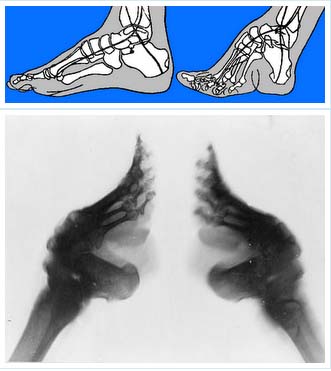 รูป X-Ray กระดูกเท้าที่ผิดรูป พร้อมกับภาพลักษณะกระดูกของเท้าดอกบัว