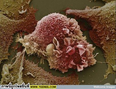 9. Lung Cancer Cells ภาพนี้เป็นภาพของ Cell มะเร็งภายในปอดครับ