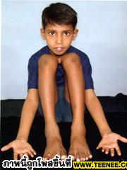 เด็กที่นิ้วมากที่สุดในโลก มือ 12 นิ้ว เท้า 13 นิ้ว 