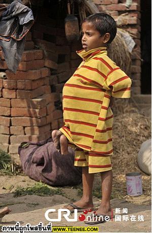 เด็กชายอินเดียที่มีเท้างอกที่หน้าอก... น่าสงสารจัง™ ℡