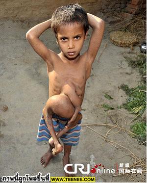 เด็กชายอินเดียที่มีเท้างอกที่หน้าอก... น่าสงสารจัง™ ℡
