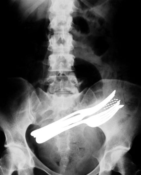 ภาพ X-Rays วัตถุประหลาดในร่างกายมนุษย์