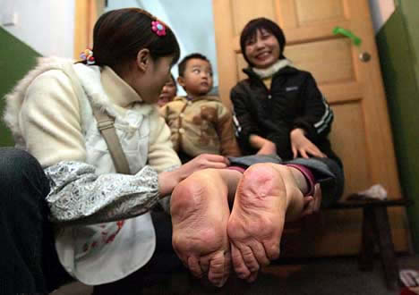 ผู้หญิงมีเท้ากลับด้าน (ประเทศจีน)