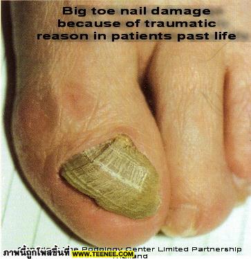 โรคเกี่ยวกับเท้า...อวัยวะสำคัญที่ถูกมองข้าม