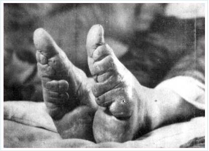 เท้าดอกบัว ( Foot Binding )